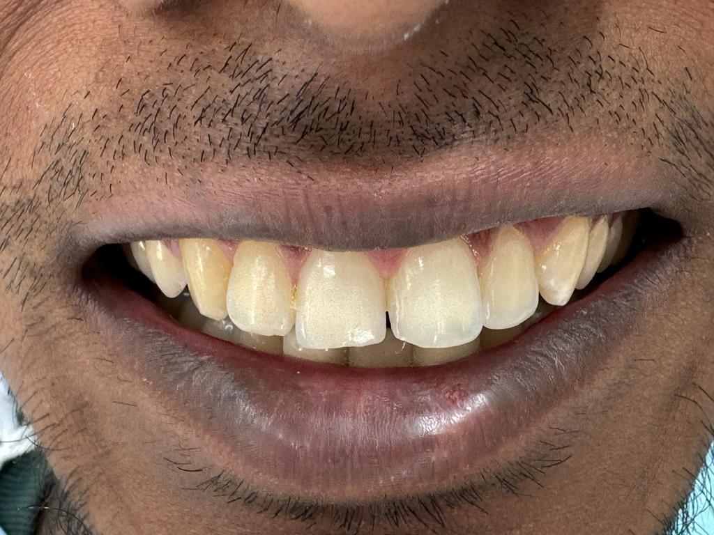 Aesthetic reshaping before treatment